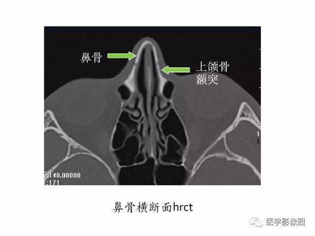 别再说难了,手把手教您学鼻腔鼻窦及颅底ct影像解剖