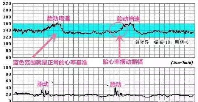 教你怎么看胎心监护曲线图