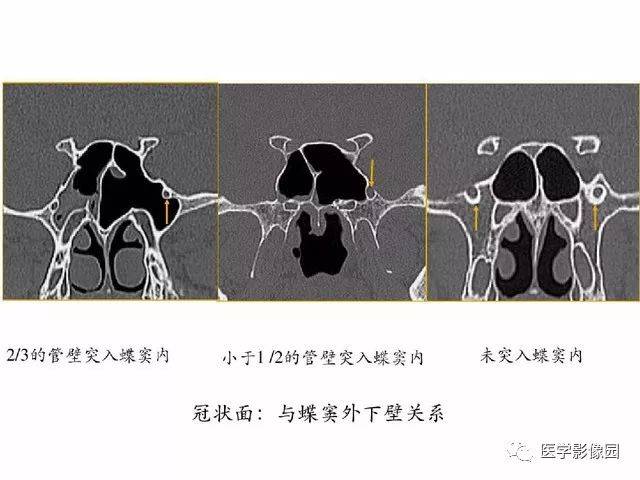 别再说难了,手把手教您学鼻腔鼻窦及颅底ct影像解剖