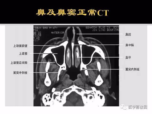 别再说难了,手把手教您学鼻腔鼻窦及颅底ct影像解剖