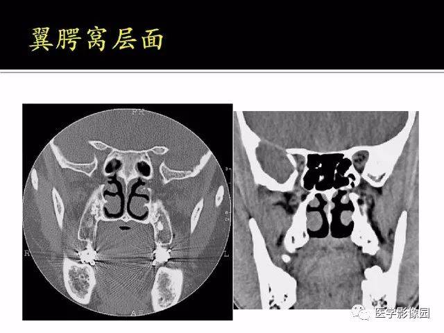 别再说难了,手把手教您学鼻腔鼻窦及颅底ct影像解剖