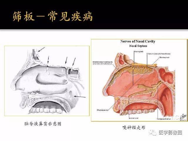 别再说难了,手把手教您学鼻腔鼻窦及颅底ct影像解剖