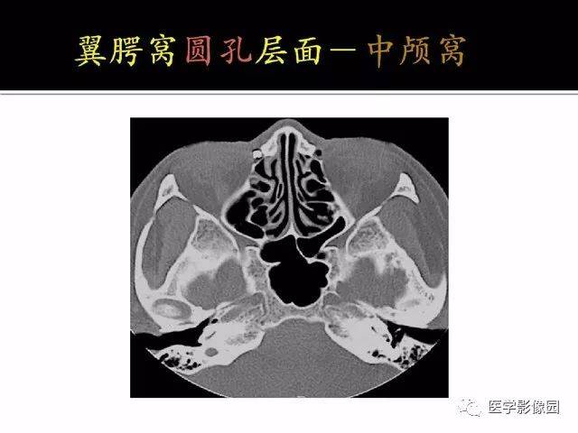 别再说难了,手把手教您学鼻腔鼻窦及颅底ct影像解剖
