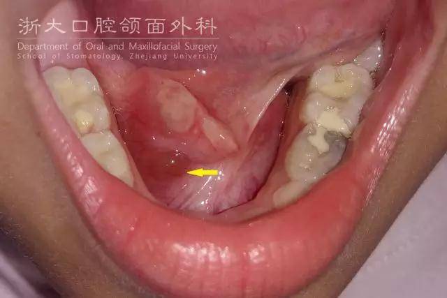 口外型舌下腺囊肿穿刺可见淡黄色黏稠液体,可拉丝