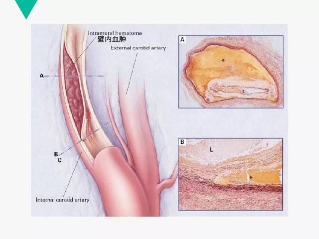 颈动脉夹层是指颈部动脉内膜撕裂导致血液流入其管壁内形成壁内血肿