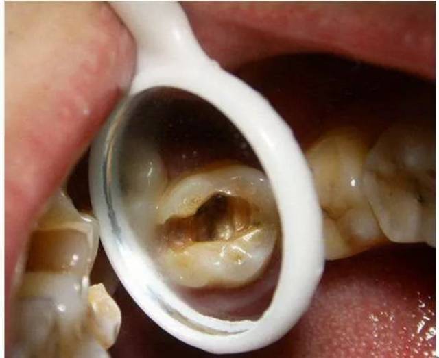 患乳牙龋齿的原因,乳牙龋齿要不要补,乳牙龋齿怎么治疗