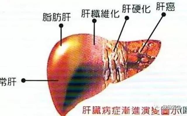 把吃出来的脂肪肝吃回去!这7个食疗方,强力刮掉肝上脂肪!