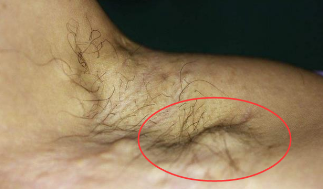 女人乳腺癌有什么症状