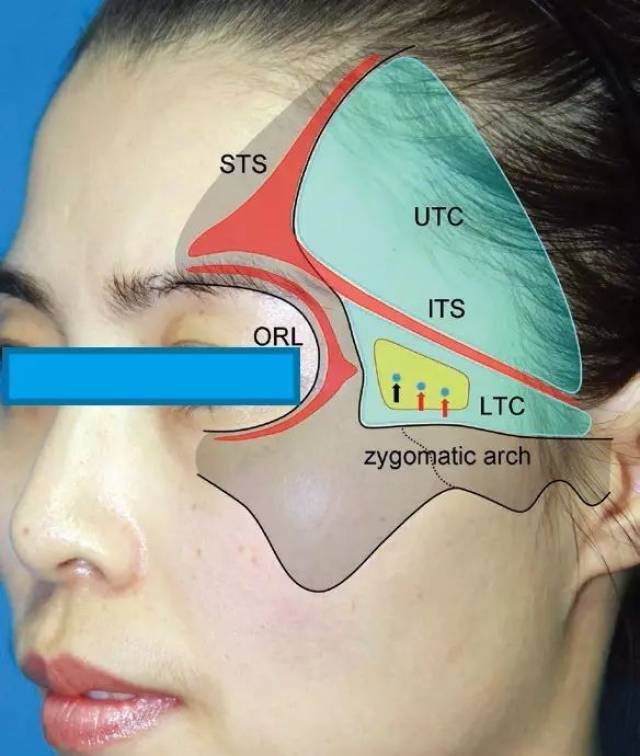 颞部解剖间隙在填充注射中的应用