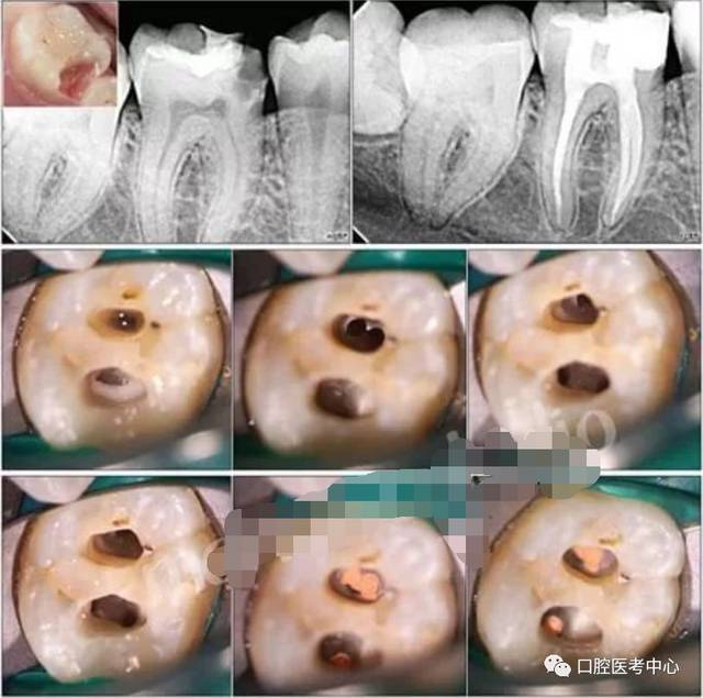 根管治疗的整个流程大致分为以下三步