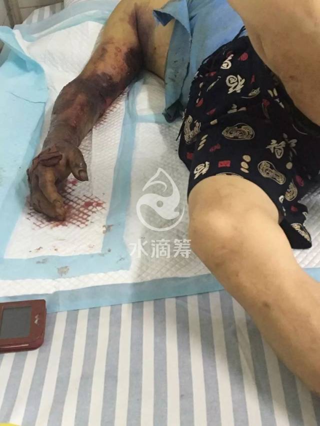 新宁那个被五步蛇蛇毒缠身的男子,惨状让人落泪!