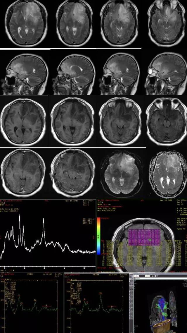 左侧额颞岛叶弥漫性胶质瘤一例(2018华东胶质瘤mdt病例四-浙二神外
