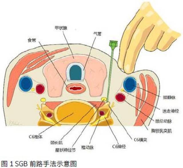 [研究]星状神经节阻滞的应用及操作-倪兵 |宣武功能神