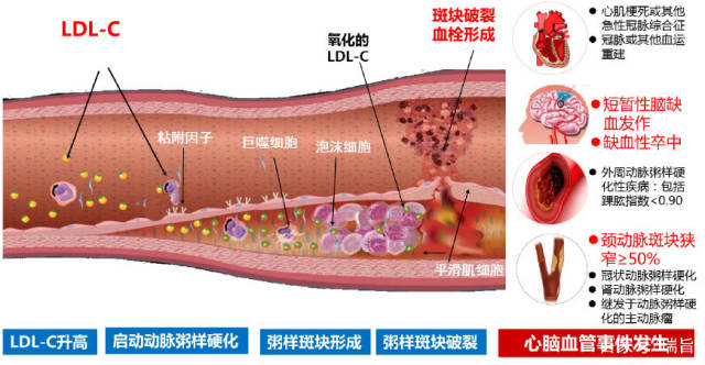 血液中的水垢就是血液中脂质,主要是坏的胆固醇--低密度脂蛋白胆固醇
