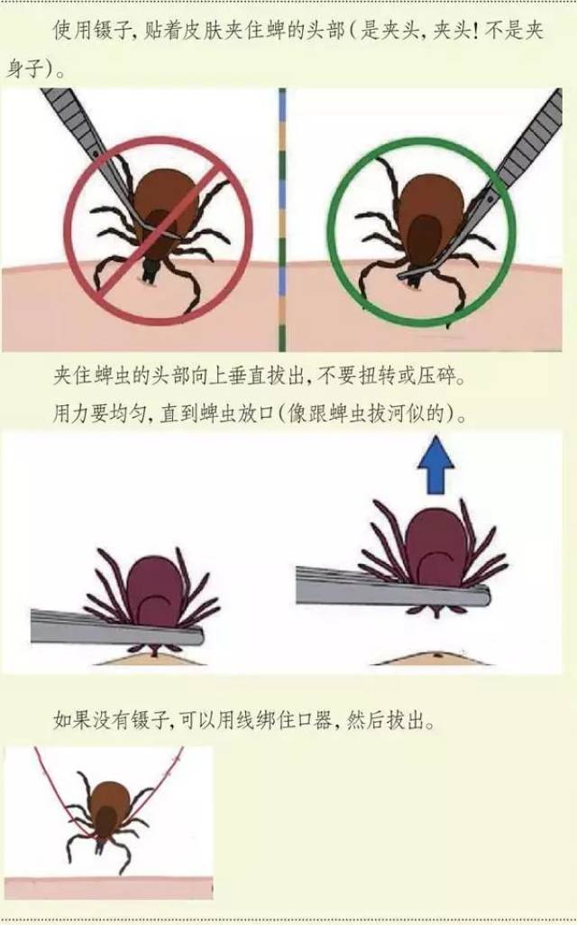 拔出蜱虫的正确方法如下