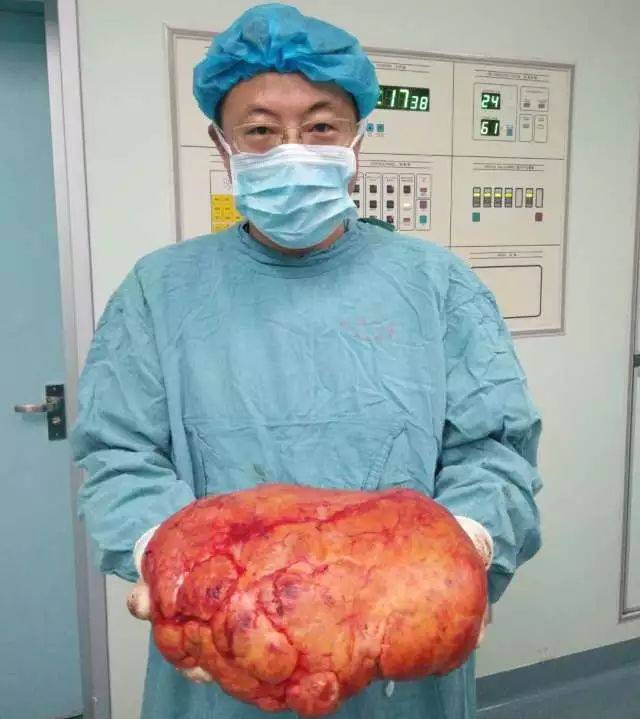 omg!他的肾脏里长了一个8斤重的瘤子.