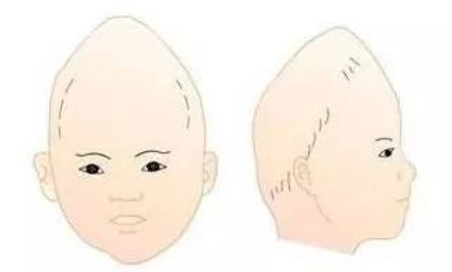 颅缝过早闭合可形成不同形状的畸形头颅,如扁头,舟状头,尖头,小头畸形