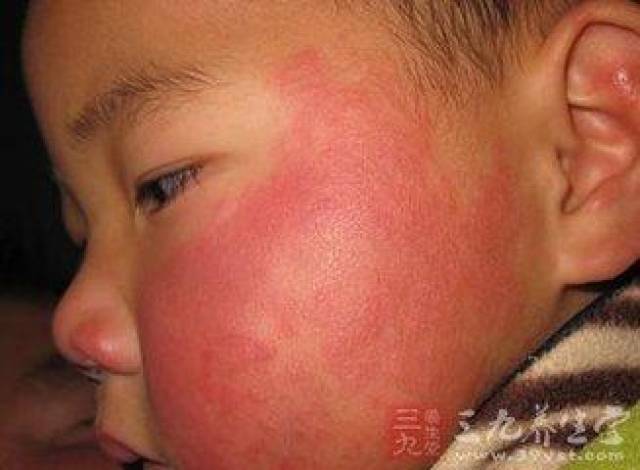 夏季来临~警惕丹毒