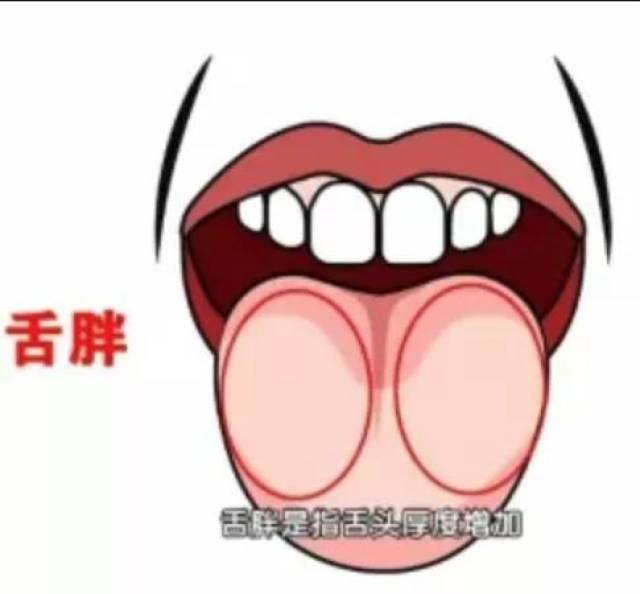 脾胃运化失调舌相 胖大嫩 很多人都知道,舌头上出现了齿痕,提示