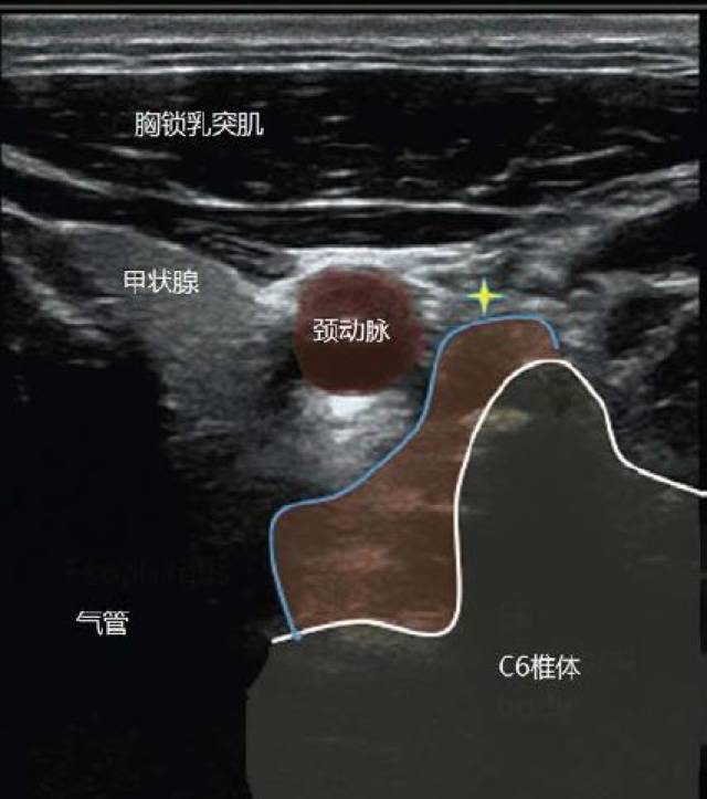 [研究]星状神经节阻滞的应用及操作-倪兵 |宣武功能神