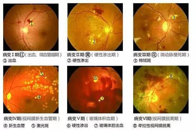 糖网导致视力障碍的主要原因是 黄斑水肿,玻璃体出血和视网膜脱离.