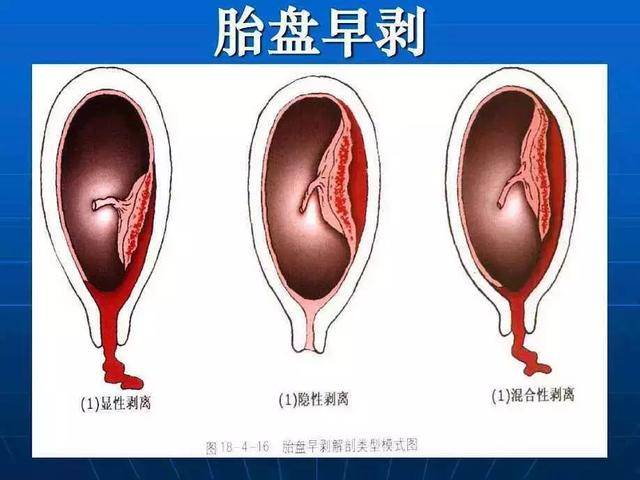 一场"胎盘不守规矩"引起的紧急抢救!