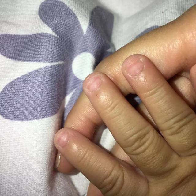 宝宝小指甲隐藏健康大秘密!长倒刺,有白点,凹痕代表什么?
