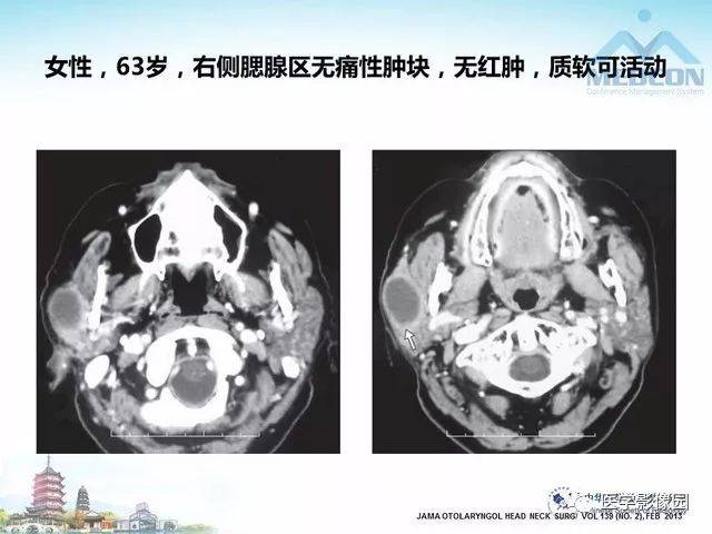 腮腺区结核与其他感染性疾病的影像诊断及鉴别诊断