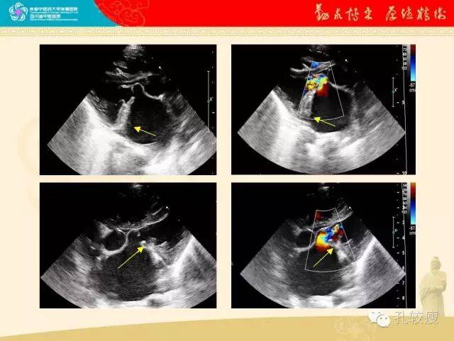 超声心动图检查提示二尖瓣后瓣上有一处纤维环(箭头,致使瓣膜开放