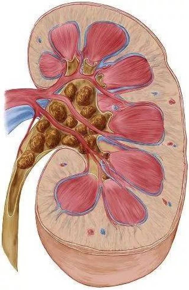 【健康】体外碎石—— 让结石患者轻轻松松 远离疼痛!