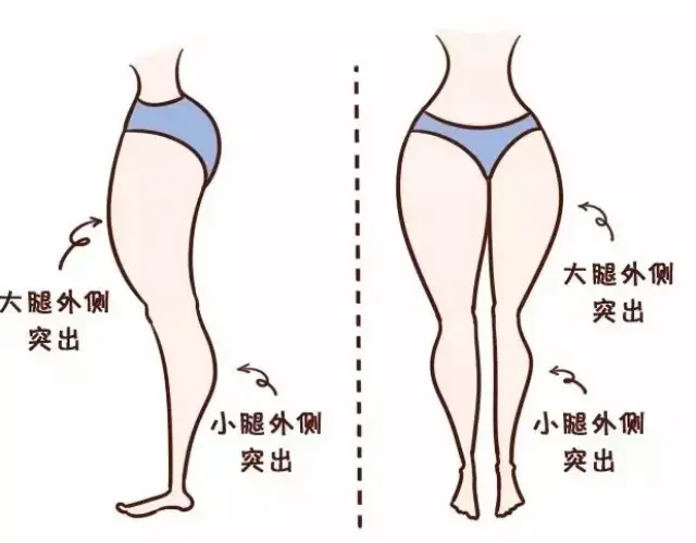复合型腿粗: 腿的形态有问题, 膝盖内侧没有紧贴, 向外侧凸出, 而且腿