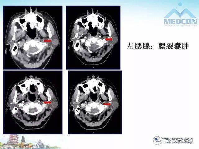 腮腺区结核与其他感染性疾病的影像诊断及鉴别诊断 | 影像天地