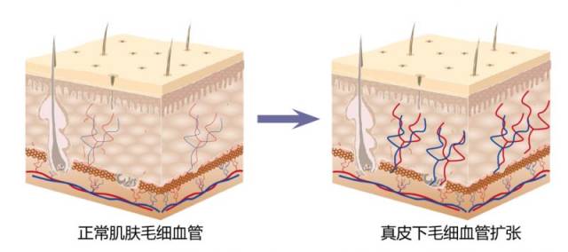 敏感性肌肤是一种问题性皮肤,实际上就是指皮脂膜和角质层受损的皮肤