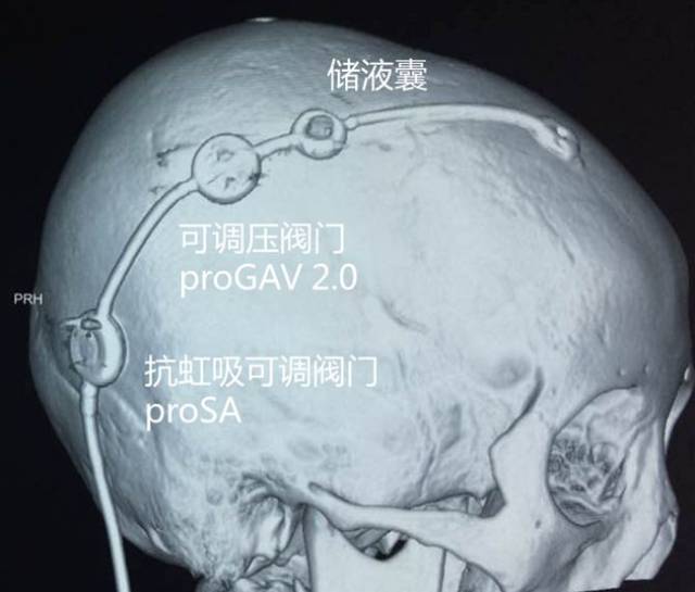 双可调压分流管治疗正常颅压脑积水及其术后动态压力调整