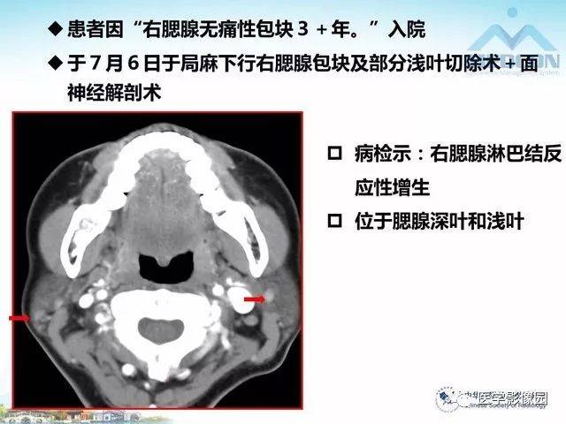 腮腺区结核与其他感染性疾病的影像诊断及鉴别诊断