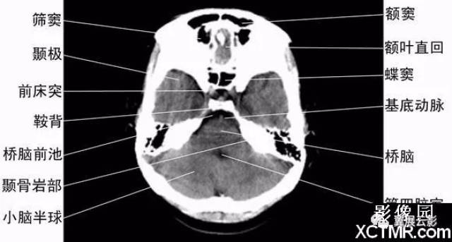 颅脑横断面ct解剖(附口诀)