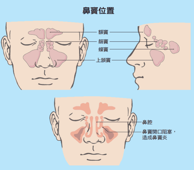 (2) 慢性鼻窦炎的症状如下: 1.