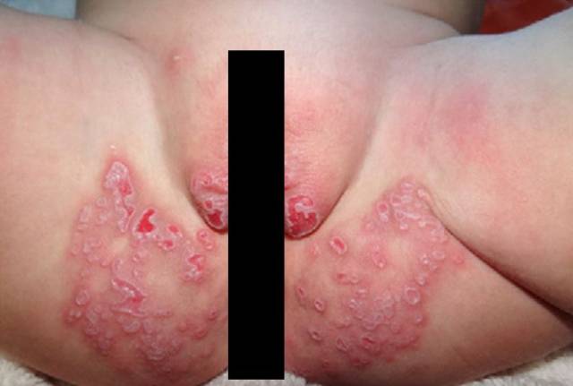 有奖病例竞猜 第144期丨1岁小宝宝的"尿布疹"反复发作