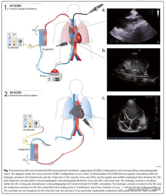 vv ecmo和va ecmo