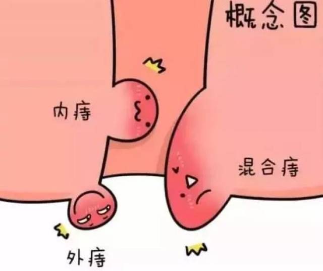 根据发生部位的不同,痔疮分为内痔,外痔,混合痔.