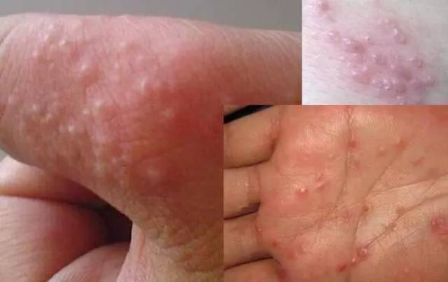 1 汗疱疹的发生有明显的季节性,多于春夏之交发病,入冬自愈,要见于