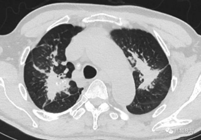 双语病例丨进行性大量肺纤维化(复杂矽肺)x/ct