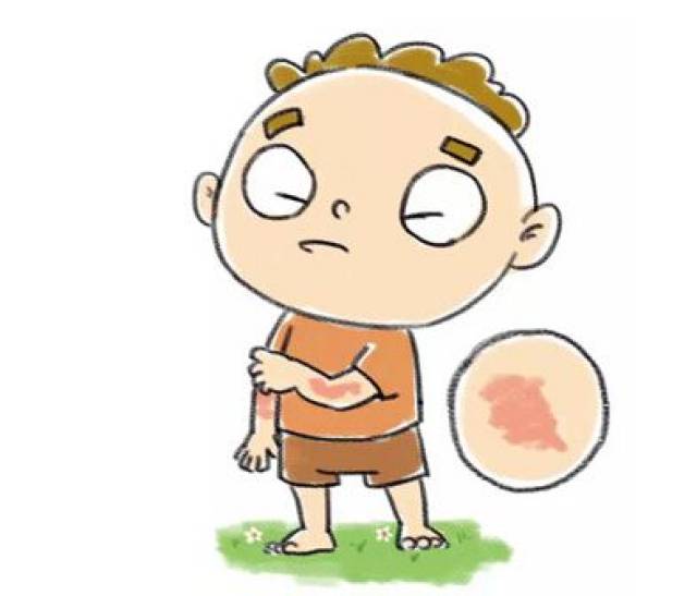 宝宝荨麻疹不能拖延治疗 妈妈选择方法真的很关键!