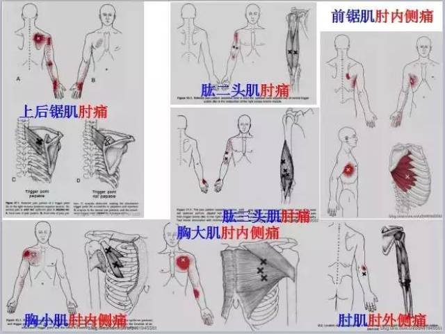 康复师必备的《全身激痛点手册》肌筋膜疼痛