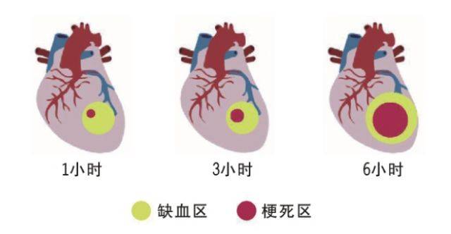 把握"黄金120分钟",发生急性心肌梗死首选胸痛中心