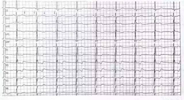 解析:心电图诊断为:二度Ⅱ型房室传导阻滞(莫氏阻滞).