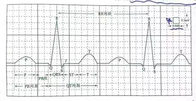助记口诀 ①心电图的坐标纸,每大格(粗实线)含有5小格(细虚线),每小