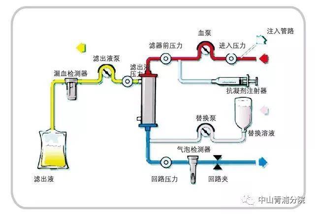 双重血浆置换