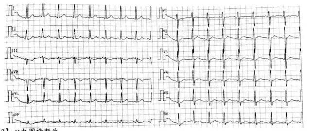 解析:心电图诊断为:窦性心动过速