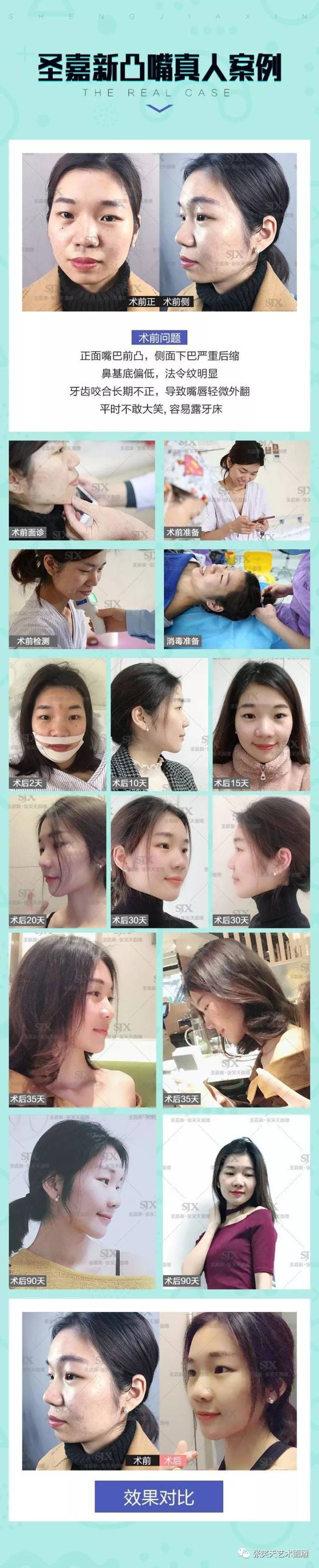 在医学上也叫龅牙凸面型,实际上是因为上颌骨突出,下颌短小后缩造成的